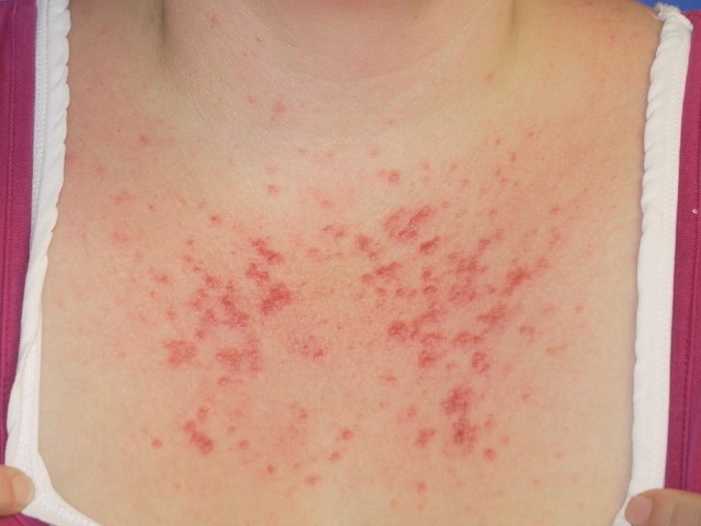 Sun allergy PMLE on the chest